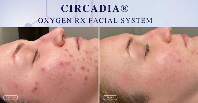 Breathe New Life Into Your Skin with the Oxygen Rx Facial